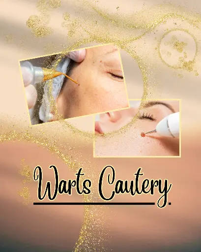 WARTS CAUTERY